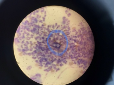 Blastomycosis in the Upper Peninsula