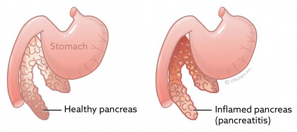 Pancreatitis and Pork